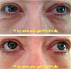 Ultimate Young - Anti-Aging der neuen Art Faltenfrei in wenigen Minuten